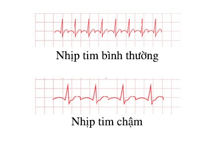 Toàn cảnh về bệnh nhịp tim chậm?