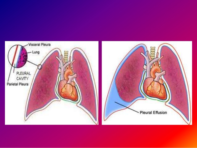 Top những điều cần biết về bệnh lao màng phổi?